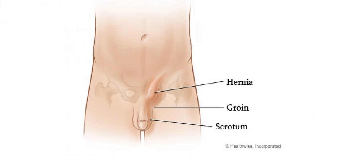 <p>inferior or lateral; Relating to the groin area, specifically the crease where the thigh meets the abdomen.</p>