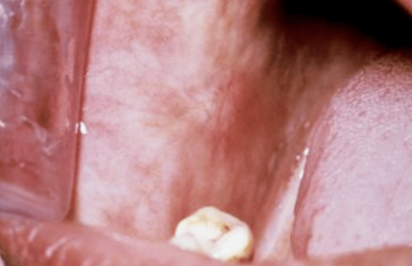 <p>Oral Submucous fibrosis</p>