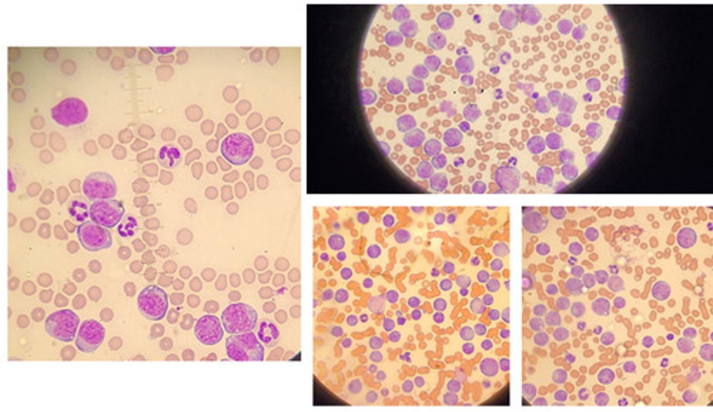 <p>A dog presented with a high leukocyte count, more than 10 fold increased. Up to 25% of leukocytes were smudged basket cells. They has small size, less han that of a neutrophil, round nuclei and a slight amount of cytoplasm with no granulse of vacuoles. What is the most likely diagnosis?</p>