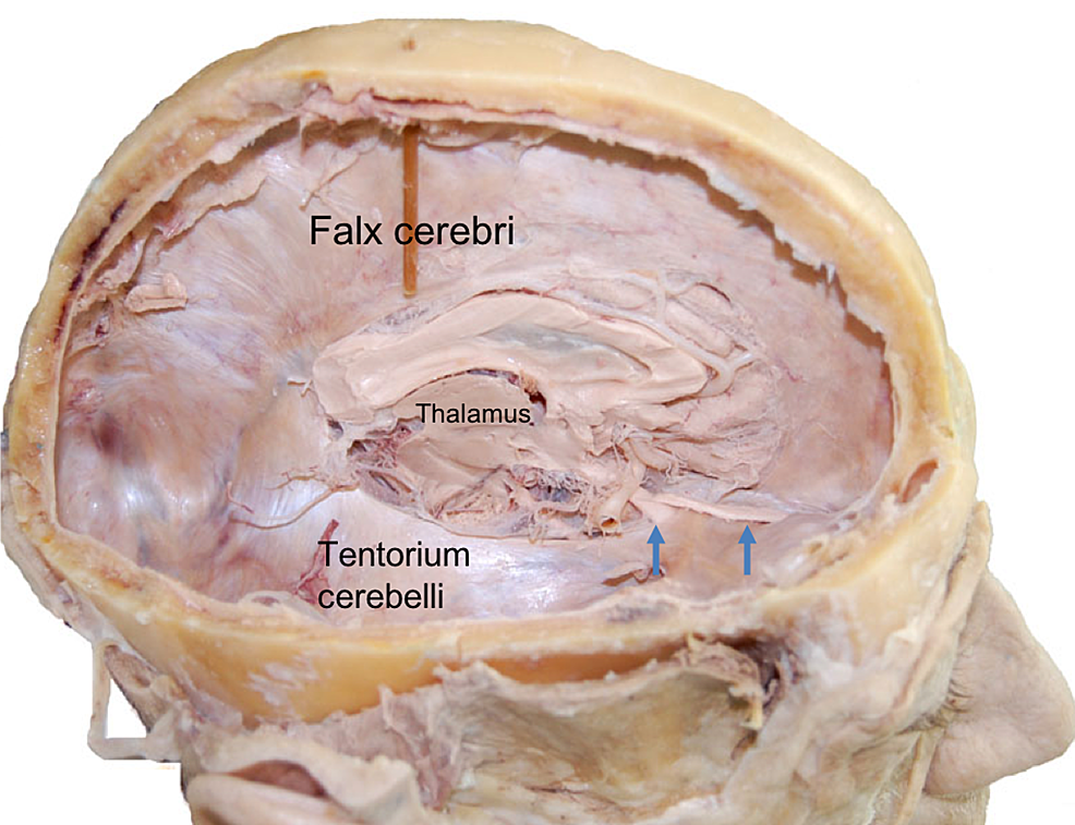 <p>tent-like partition in the transverse fissure separating the occipital lobes from the cerebellum</p>