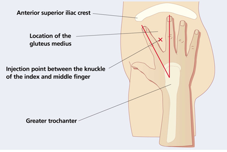 <p>Place heel of hand over the greater trochanter with thumb pointing toward the groin and index finger pointing toward iliac crest towards clients buttock. A v-shaped is formed between the index and middle finger. Inject site is in center of V. Up to 3 mL </p>