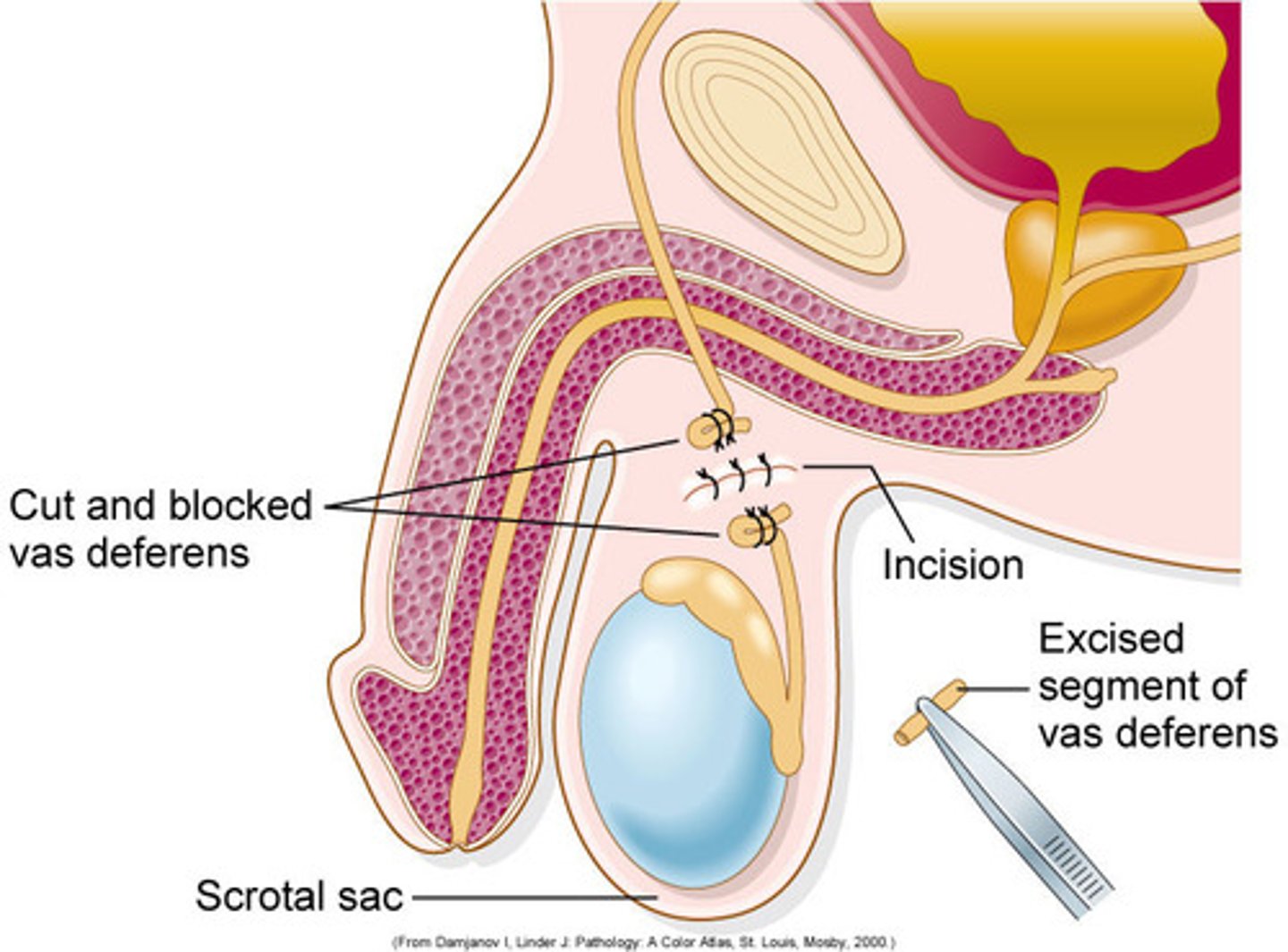 <p>removal of a segment of the vas deferens; a male sterilization procedure</p>