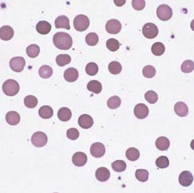 <p><span style="font-family: "Times New Roman", serif">Small, round RBCs lacking central pallor; seen in hereditary spherocytosis or autoimmune hemolytic anemia.</span></p>