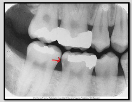 <p>What class of interproximal caries is this?</p>