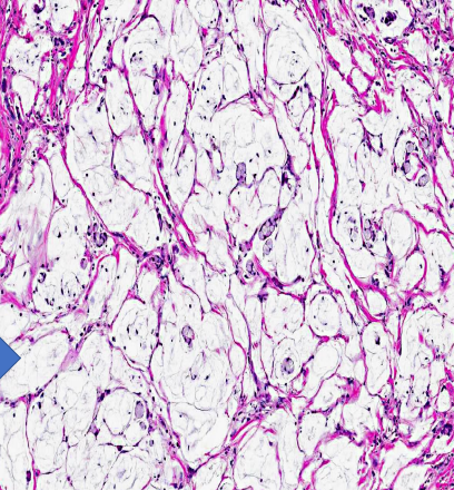 <p>identify ?</p><p>other types of carbohydrate deposits ? </p><p>other types of tissue accumulation ?</p>