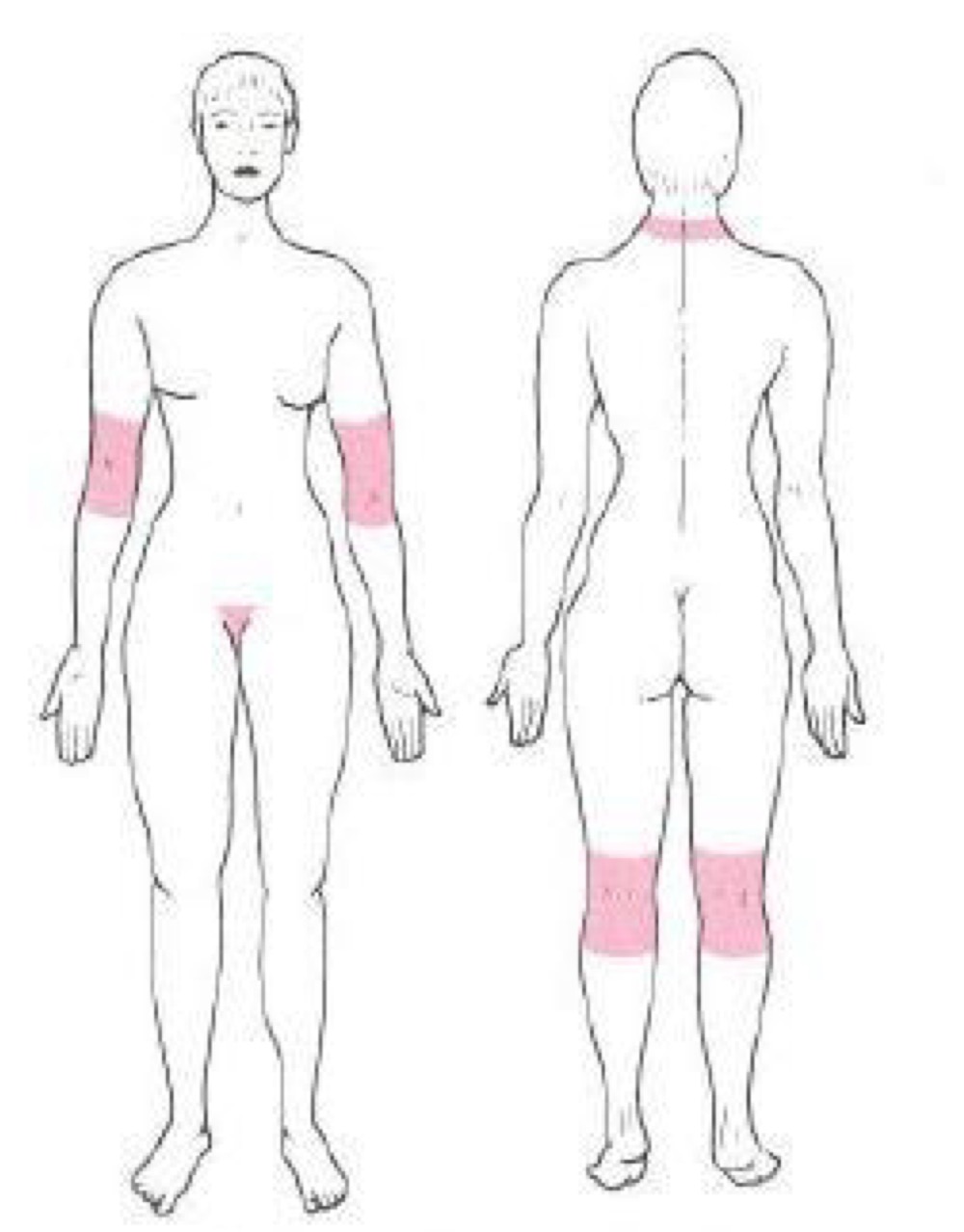 <p>what distribution of skin lesion is this </p>