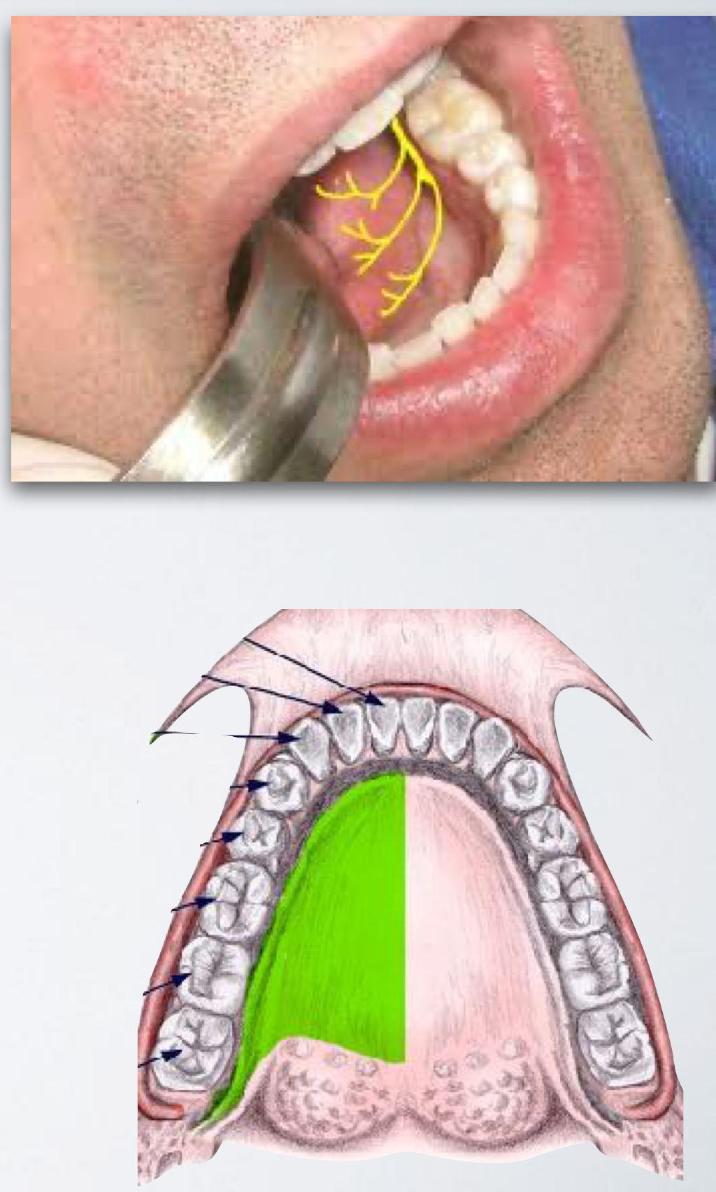 <p>Area Anesthetized:</p><ul><li><p>Lingual soft tissue</p></li><li><p>Floor of the mouth</p></li><li><p>Anterior two thirds of the tongue to midline</p></li></ul><p></p>