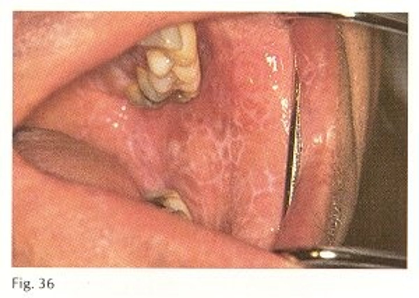 <p>lichen planus</p><p>(but it also looked like luekoedema, cheek biting, etc. and all were answer choices)</p>