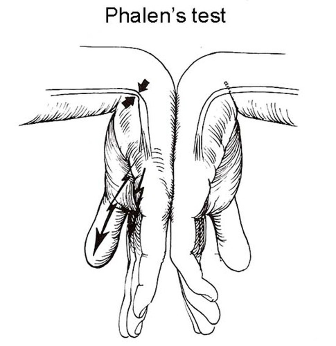 <p>tests for carpel tunnel syndrome.<br>- hold both hands back to back, flexing wrists at 90-degree angle</p>