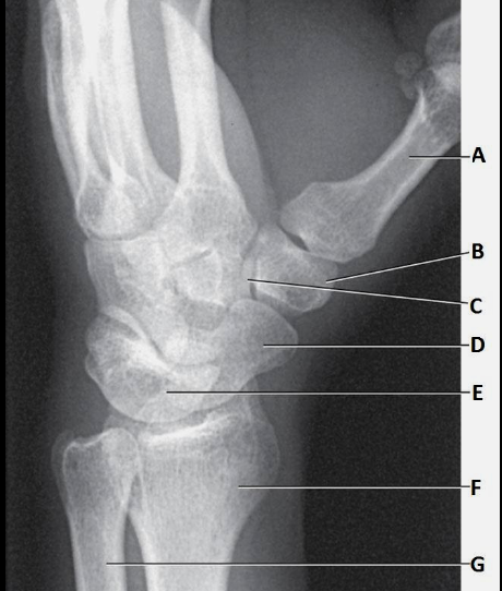 <p>What is labeled E in the image of PA oblique wrist?</p>