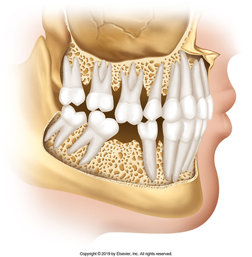 <p>Occurs when a specific tooth does not have an antagonist tooth to occlude against in the arch. When this occurs, the tooth begins to super-erupt, trying to meet an occluding force. Because of this, supporting tissues will collapse, resulting in bone loss. Replacing missing teeth is important to maintain an ideal occlusal bite. There are several options to do this; partial dentures, fixed bridges and implants are prime examples of tooth replacement.</p>