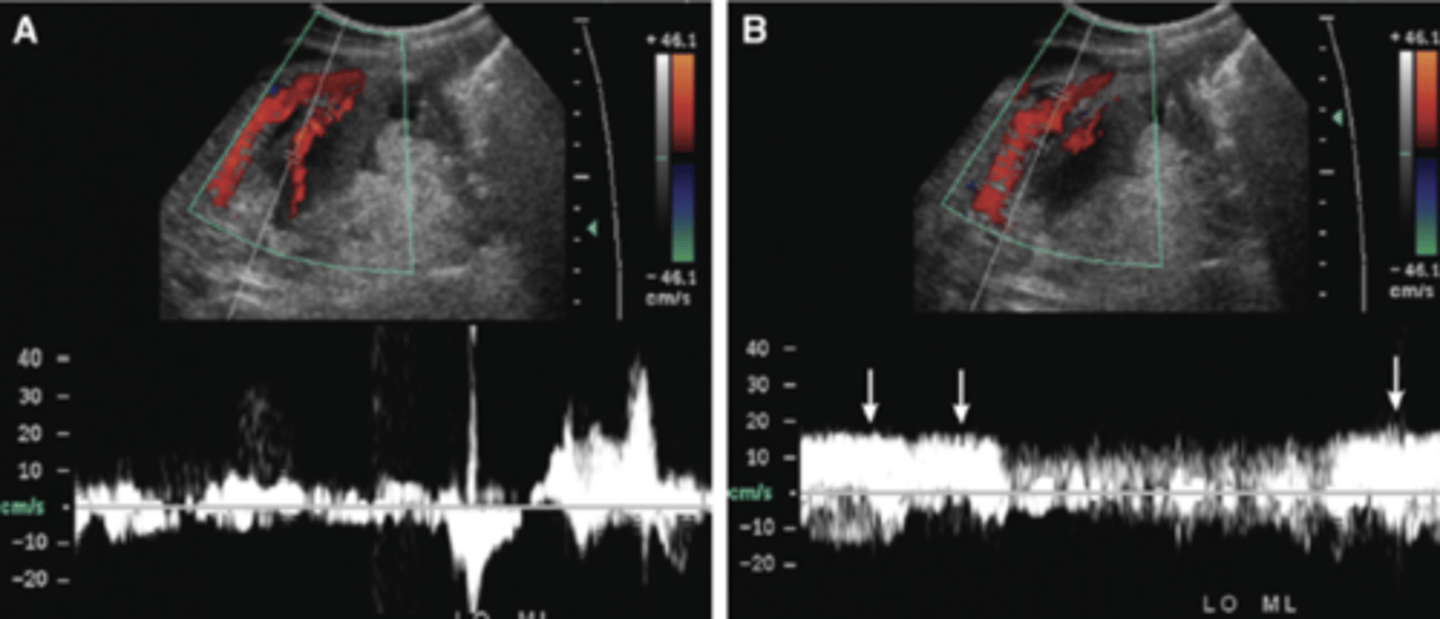 <p>Color appears in areas that do not contain blood</p><p>Shows movement of other fluids - amniotic fluid, urinary jets, ascites, pleural fluid, etc.</p>