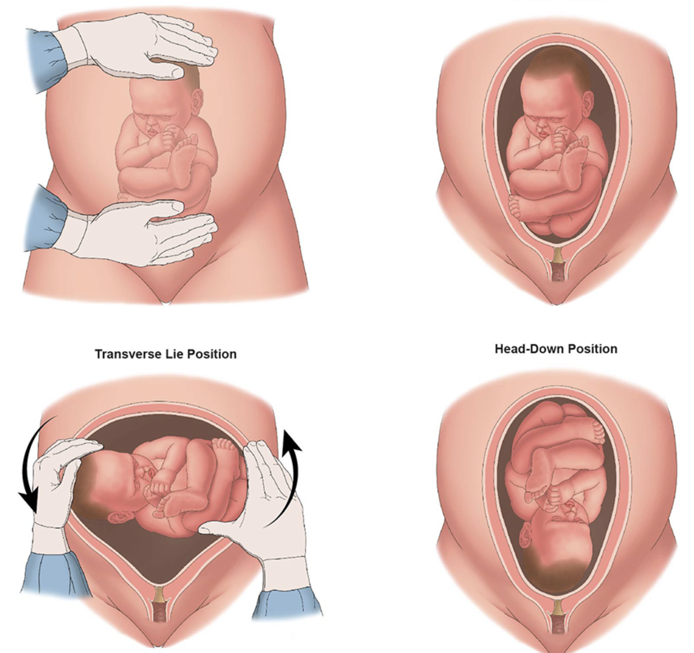 <ul><li><p>manually turning a breech fetus to a suitable postion for vag delivery </p></li><li><p><strong>terbutaline</strong> is administered to relax the uterine muscle</p></li><li><p></p></li></ul><p></p>