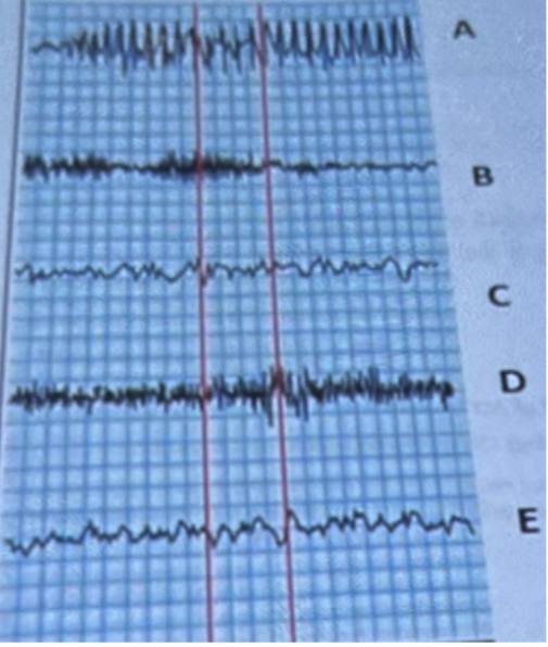 <p>Which letter in the above shows a recording from a patient with cerebral embolism?</p>
