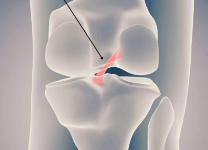 <p>A key ligament in the knee that stabilizes the joint by connecting the femur to the tibia and preventing excessive forward movement of the tibia. </p>