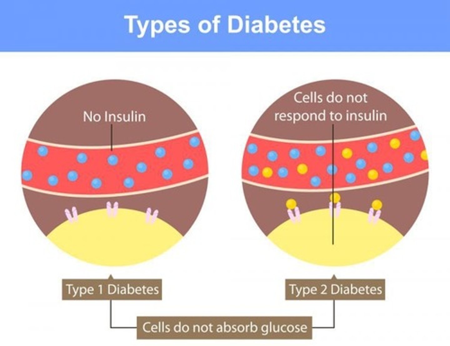 <p>In Type I Diabetes Mellitus, the Insulin itself isn't produced and can't stimulate the the insulin receptor, which would bring GLUT 4 transporters to the cell membrane.</p><p>In Type II Diabetes Mellitus, the insulin receptors are desensitized to Insulin. Insulin is trying to signal to bring GLUT 4 transporters to the cell membrane; the receptors are at fault here.</p>