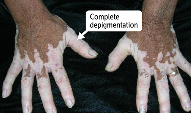 <p>melanocytes in the epidermis, causing <strong>depigmented macules and patches</strong></p>