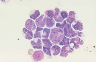 Figure 23: Medulloblastoma