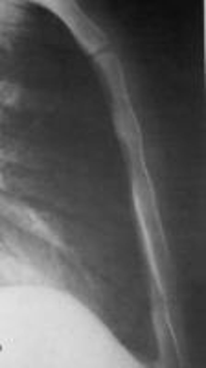 <p>Collar bones.</p>