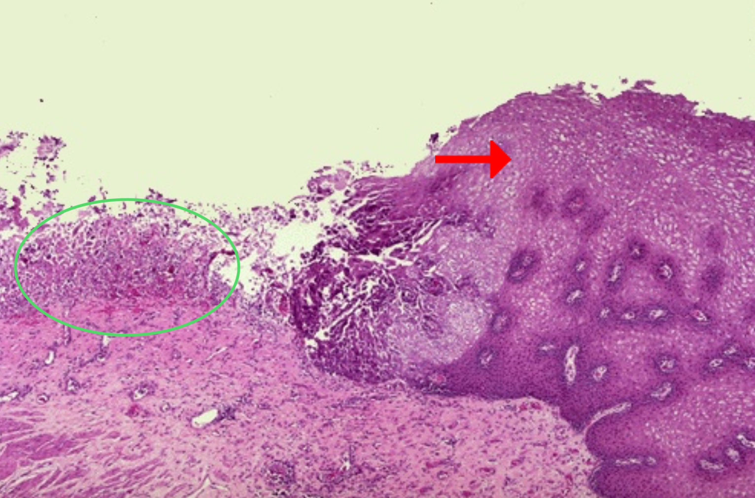 <ol><li><p>Stratified squamous epithelium</p></li><li><p>Esophageal acute ulcer</p></li><li><p>Ulceration</p></li><li><p>PMNs</p></li><li><p>lymphocytes, macrophages, and plasma cells</p></li><li><p>fibroblastic proliferation, scarring</p></li></ol><p></p><p>An ulcer is a local defect, or excavation, of the surface of an organ or tissue that is produced by the sloughing (shedding) of inflamed necrotic tissue. Ulceration can occur only when tissue necrosis and resultant inflammation exist on or near a surface. Ulcerations are best exemplified by peptic ulcer of the stomach or duodenum, in which acute and chronic inflammation coexist. During the acute stage there is intense polymorphonuclear infiltration and vascular dilation in the margins of the defect.</p>
