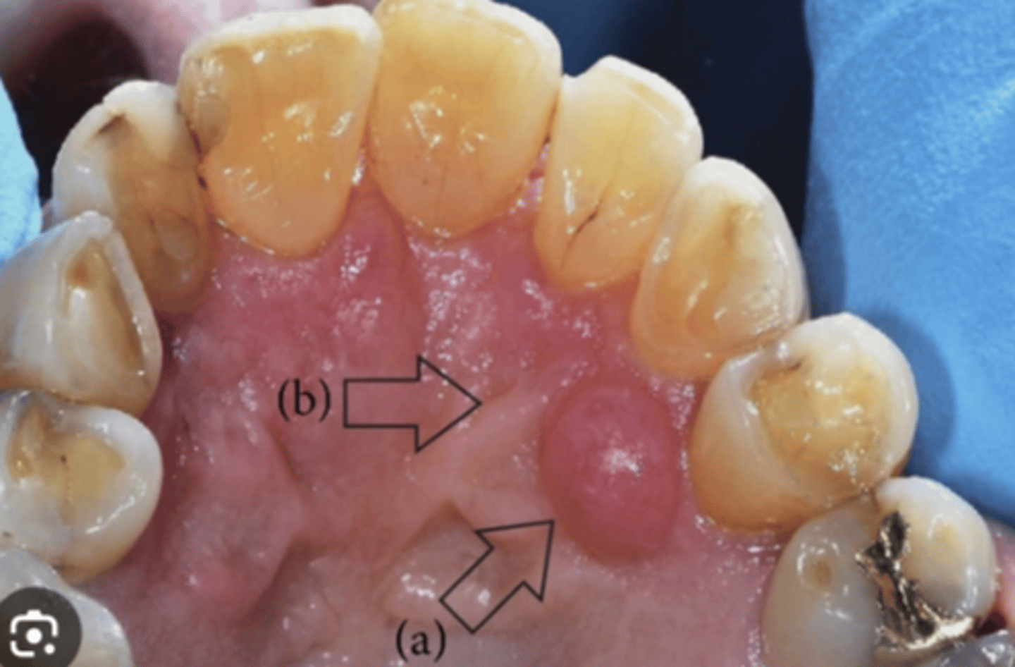 <p>- the most rare form</p><p>- pedunculate (attached to tissue via a narrow stalk) gingival lesions</p><p>- <1.5cm</p><p>- doesn't infiltrate bone</p>