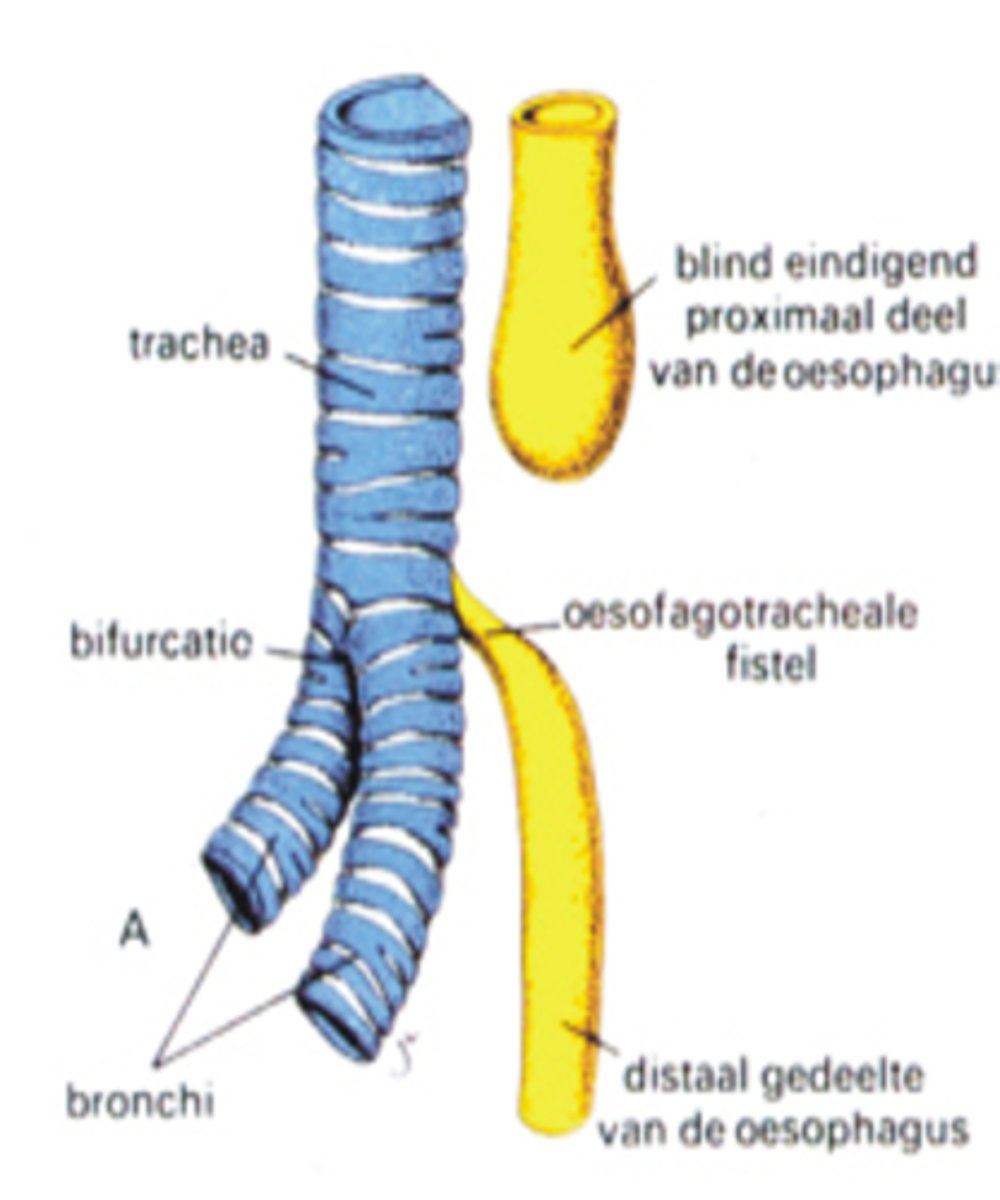 <p>Hoe wordt deze anomalie thv de caudale oesophagus genoemd?</p>