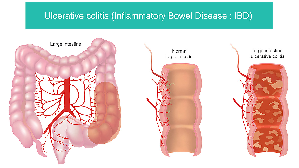 <ul><li><p>Etiology </p><ul><li><p>Not completely understood</p></li><li><p>Appears to involve environmental factors, microbial imbalance in the gut, genetic susceptibility, and inappropriate immune response</p></li></ul></li><li><p>Pathogenesis</p><ul><li><p>Inflammation of mucosal and submucosal layers of colon </p></li><li><p>Continuous lesion inflammation may extend into the proximal colon or may affect the whole colon (pancolitis)</p></li><li><p>Bowel changes include epithelial damage, inflammation, crypt abscesses, and loss of goblet cells </p></li></ul></li><li><p>Manifestations </p><ul><li><p>Bloody and/or mucoid, diarrhea, dehydration, and anemia</p></li><li><p>Crampy abdominal pain, pain with defecation and tenesmus</p></li><li><p>Involvement of the rectum may also lead to constipation </p></li></ul></li></ul><p></p>