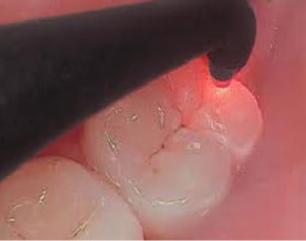 <p>A laser fluorescence device used to detect carious lesions in teeth by measuring the fluorescence emitted by decayed tooth structure, HIGHER=more decay</p>