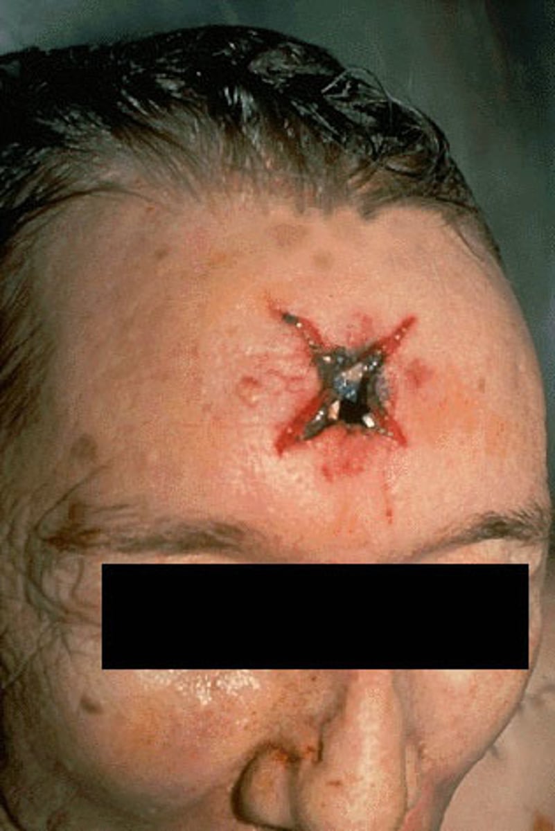<p>cone shaped, star, torn, from contact or close to contact shot</p>