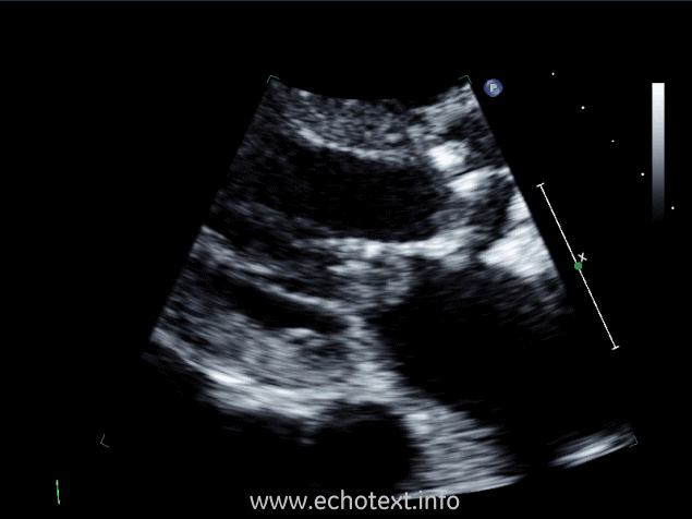 <p><span><span>Which cardiac pathology is shown below?</span></span></p><p>Mitral annular calcification and AS</p><p>Mitral valve endocarditis and AS</p><p>Mitral stenosis</p><p>Constrictive pericarditis and AS</p><p>Mitral valve prolapse and AS</p>