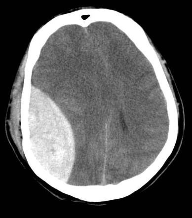 <p>Pterion → frontal, sphenoid, parietal + temporal bones</p><ul><li><p>Likely fracture site</p></li><li><p>Middle meningeal artery injured = extradural haematoma (compression of cerebral cortex)</p></li></ul>
