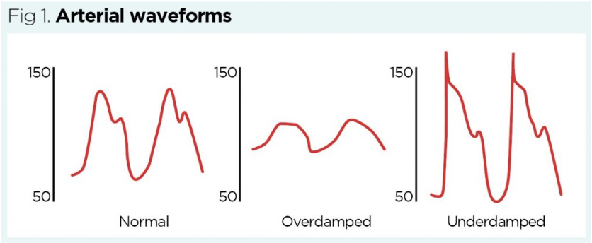 * __Normal__ → shows systolic (first peak) and diastolic (second peak)


* __Overdampened__ → NO systolic or diastolic
  * **May have to replace or flush d/t kinks or clotting in tubing**


* __Underdampened__ → doesn’t look like a normal flowing wavelength
  * **Flush this to see if this is a flow issue**