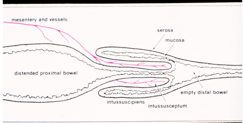 <ul><li><p>Intussusception </p></li><li><p>Ileocolic junction most common location in dogs </p></li><li><p>young animals </p></li><li><p>usually idiopathic </p></li></ul><p></p>