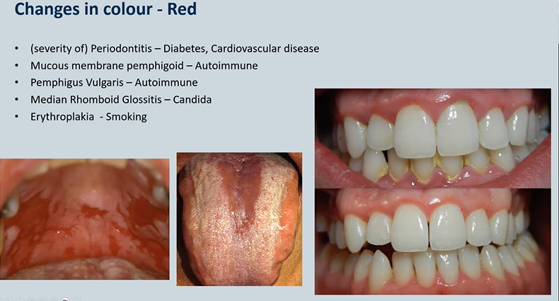 <ol><li><p>(severity of) <strong>Periodontitis </strong>– Diabetes, Cardiovascular disease</p></li><li><p><strong>Mucous membrane pemphigoid </strong>– Autoimmune</p></li><li><p><strong>Pemphigus Vulgaris </strong>– Autoimmune</p></li><li><p><strong>Median Rhomboid Glossitis</strong> – Candida</p></li><li><p><strong>Erythroplakia</strong> - Smoking</p></li></ol><p></p>