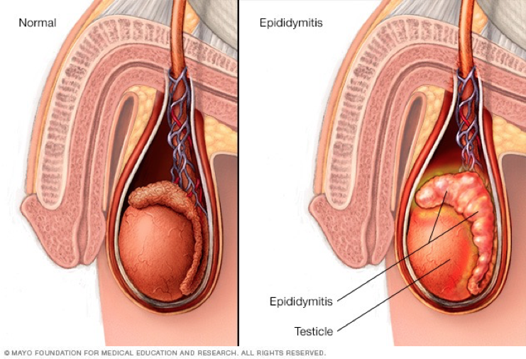 <p>Epididymitis</p>