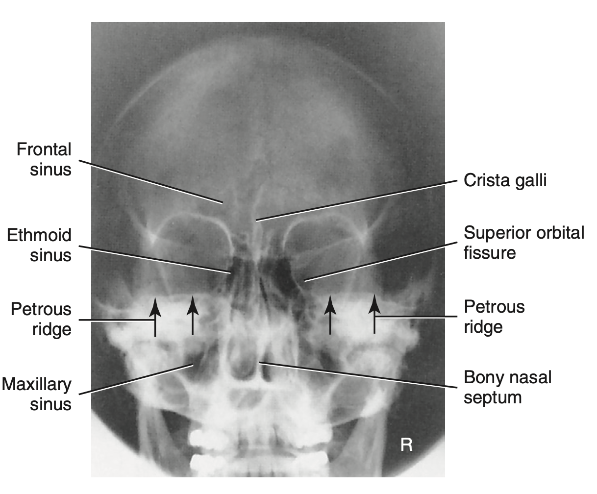 <p>How do you <u>critique</u> radiograph of <strong>PA axial: Caldwell (no angle) </strong>for <strong>sinuses?</strong></p>