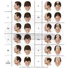 <p>E: genetics<br>sensitivity to DHT (dihydrotestosterone)</p><p>CM:<br><u>male:</u><br>front temporal areas+vertex of scalp</p><p><u>female:</u><br>crown of head<br>retaining frontal hairline</p><p>TX:<br><u>male:</u><br>topical/PO minoxidil<br>PO spironolactone</p><p><u>female:</u><br>topical minoxidil<br>PO finasteride</p>