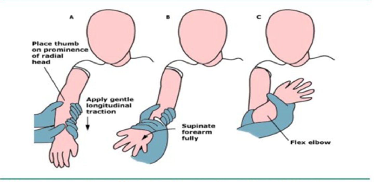 <p>manual reduction</p><p>- have the child extend their elbow w/ their arm hanging down in a natural position, turn their palm forward (supinate), then flex the elbow (keeping the palm in the supine position)</p><p>- alt. technique = hyperpronation</p>