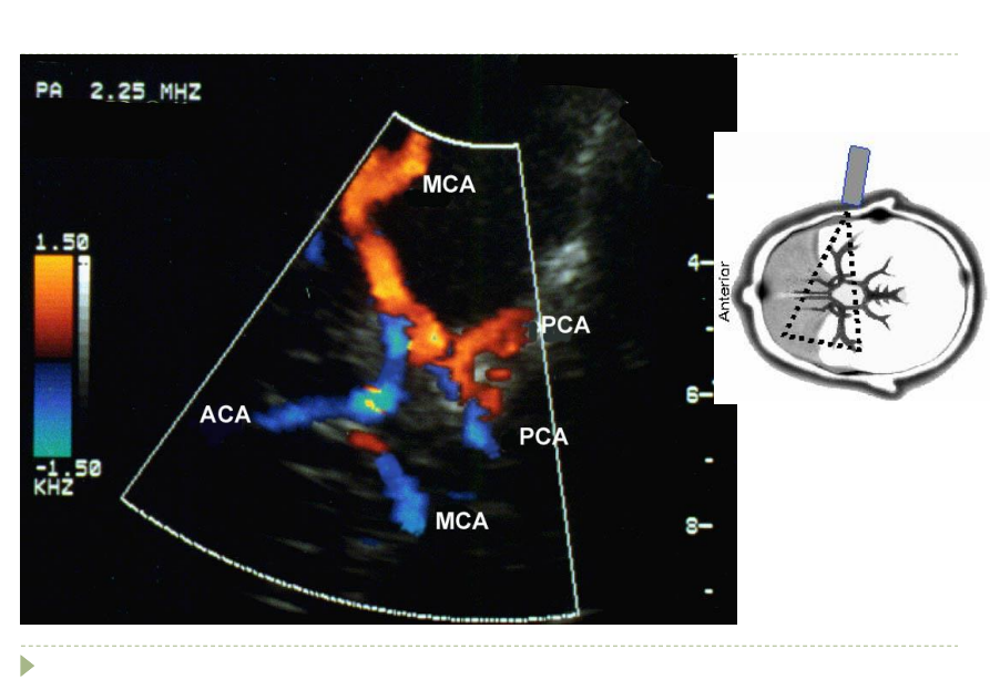 <p>Transtemporal Window  Image orientation  Ipsilateral hemisphere is at the “where” of monitor-Contralateral hemisphere is at the where</p><p>Anterior to the right or left and posterior to the right or left</p>