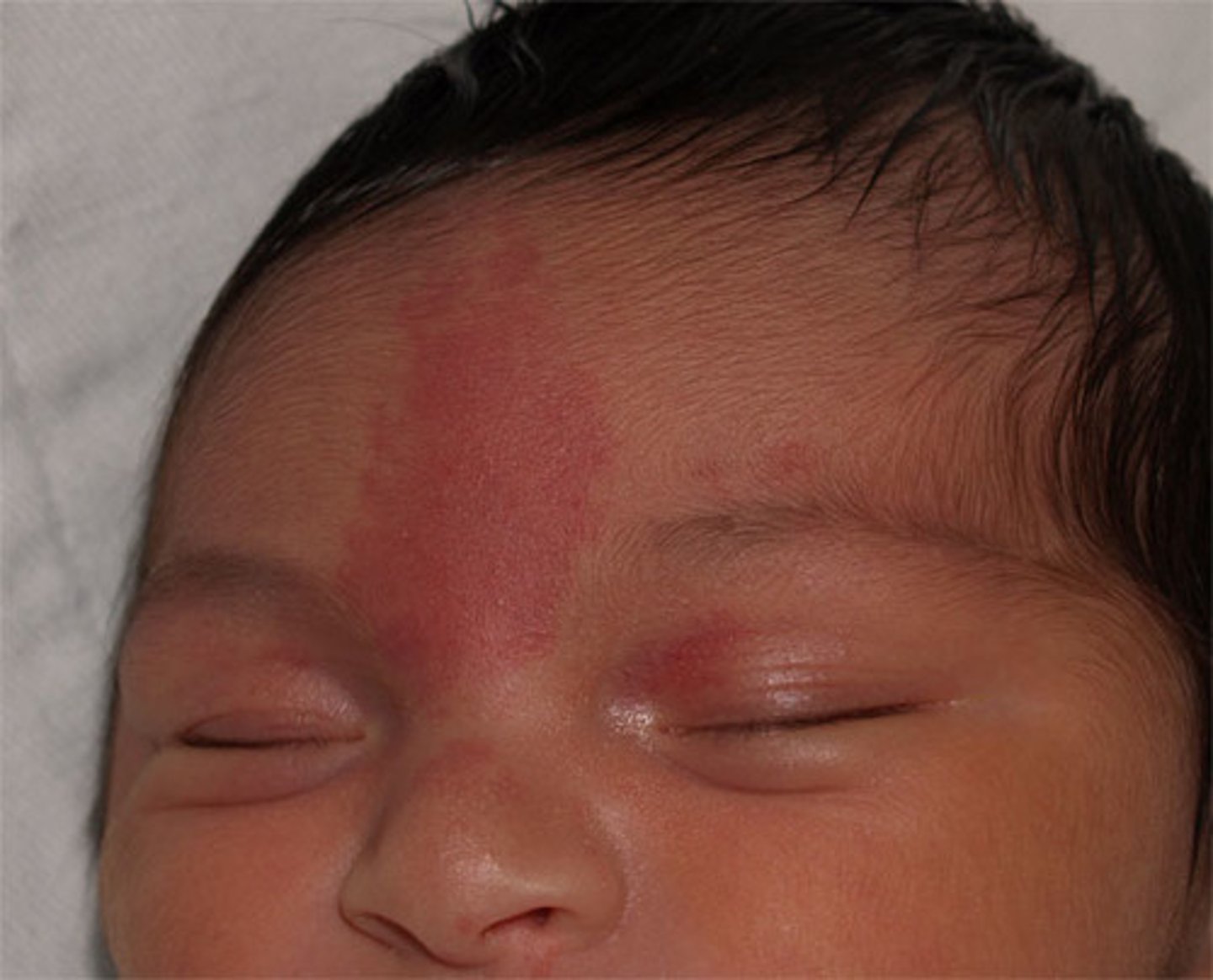 <p>"stork bite", pink red capillary on face or neck</p>