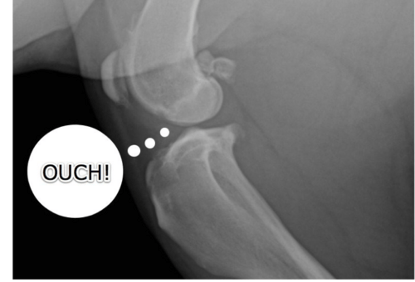 <p>sudden lameness in dog w/ CCL rupture may indicate ____</p>