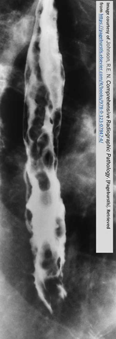 <ul><li><p>barium swallow will show the impact </p></li><li><p>endoscopic U/S can diagnose </p></li><li><p>radiographic signs XR</p><ul><li><p>rosary beads (oval filling defects)</p></li><li><p>worm tracings (long wavy impressions)</p></li></ul></li></ul><p></p>