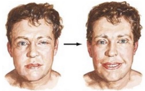<p>what does myasthenia gravis lead to (neuromuscular junction disorder)</p>