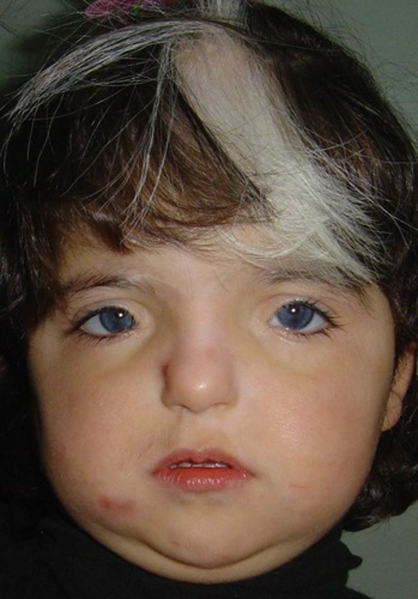 <p>Autosomal dominant, or assoc w/ advanced paternal age. Short palpebral fissures, white forelock and deafness.</p>