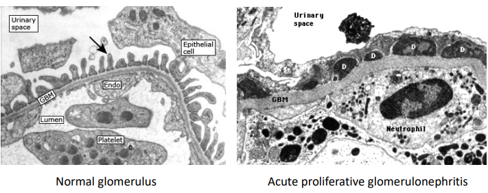 <p>Compare these electron microscopy images:</p><ul><li><p>Dark patches (D) showing subepithelial immune deposits </p></li><li><p>Neutrophil attached to GBM</p></li></ul><p></p>