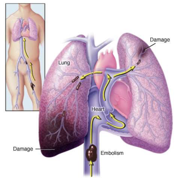 <p>blockage in the arteries bringing blood to the lung tissue (usually a clot), which leads to lung tissue damage </p><ul><li><p>trachea = midline </p></li><li><p>tactile fremitus = normal </p></li><li><p>percussion = resonant </p></li><li><p>breath sounds = vesicular </p></li><li><p>adventitous sounds = usually none </p></li><li><p>may be accompanied by SOE/DOE, tachycardia, pain with inspiration, cardiac arrest </p></li></ul><p></p>