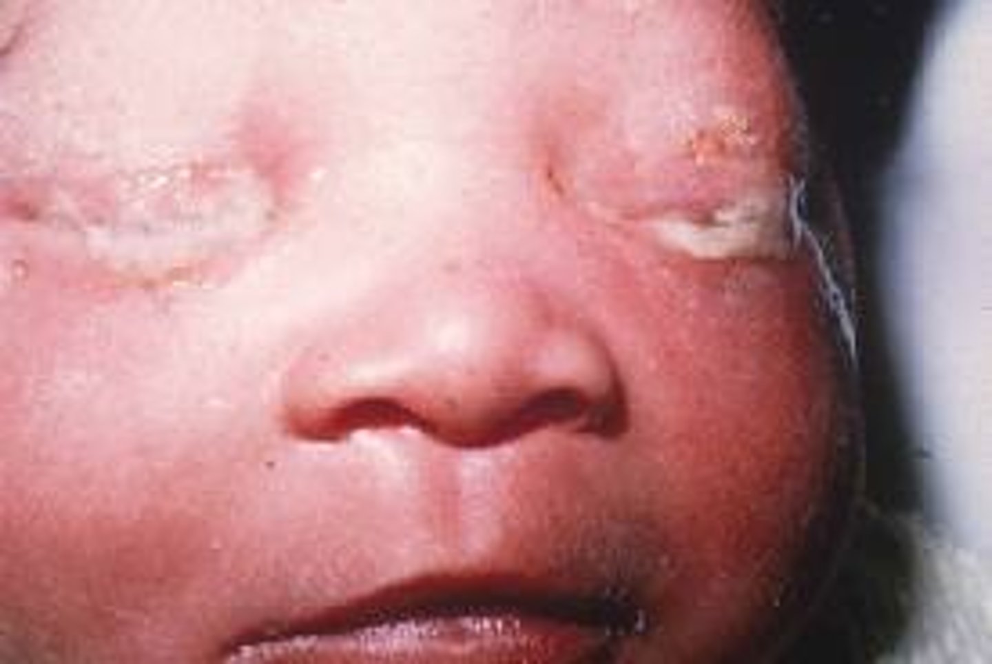 <p>Neonatal conjunctivitis: DOL 3-5, bilateral purulent conjunctivitis can cause corneal ulceration.</p>
