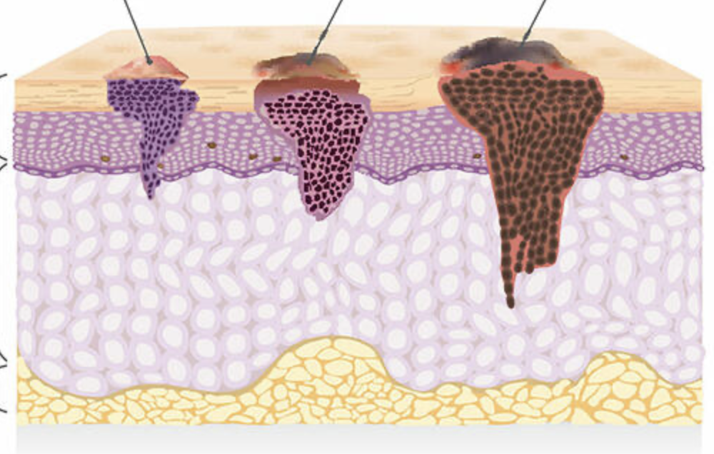 <p>what are the 3 different types of skin cancer?</p>