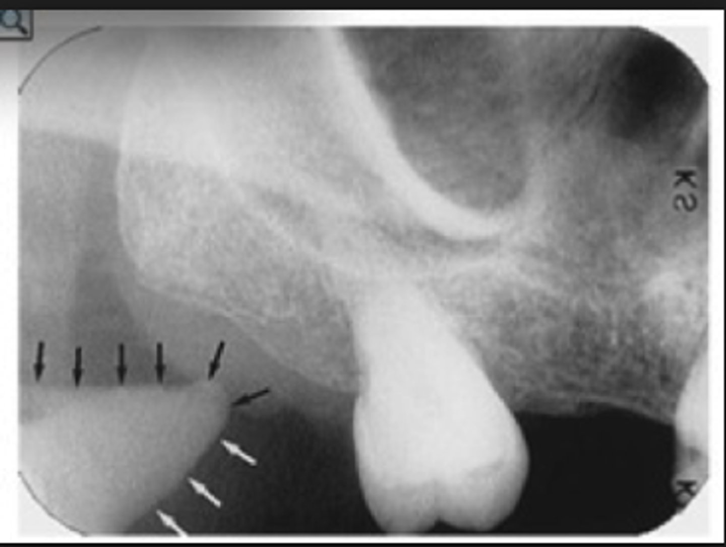 <p>often seen in maxillary posterior PAs</p>