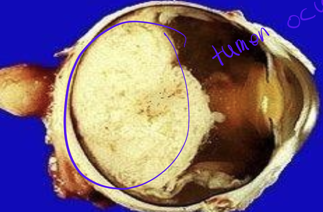 <p>Identify the <strong>organ</strong> and the <strong>diagnosis</strong> in this format: <em>diagnosis, organ</em></p>